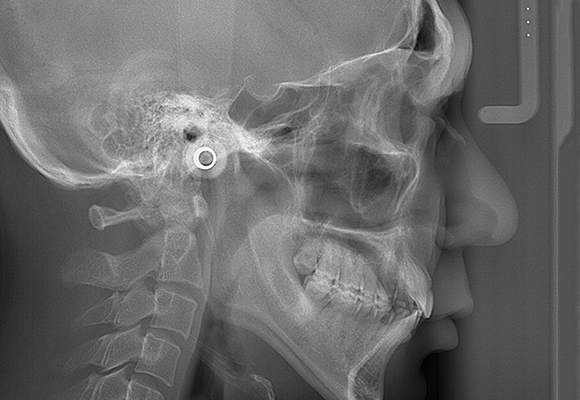 [写真]矯正治療を検討している方へ2